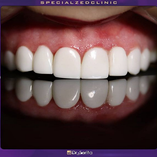 ایمپلنت بهتر است یا کامپوزیت,تغییر رنگ دندان,درمان فاصله بین دندان