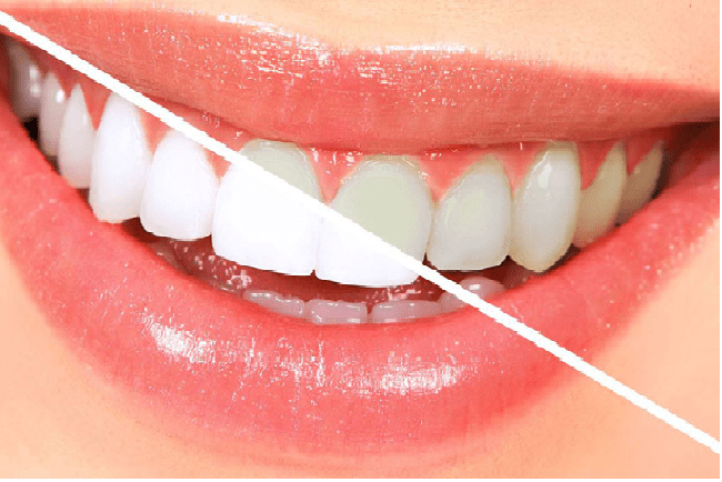 کامپوزیت ای پی اس (IPS)،یکی از انواع کامپوزیت دندان
