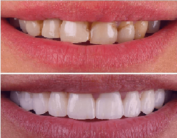 کامپوزیت ماکروفیل، یکی از انواع کامپوزیت دندان