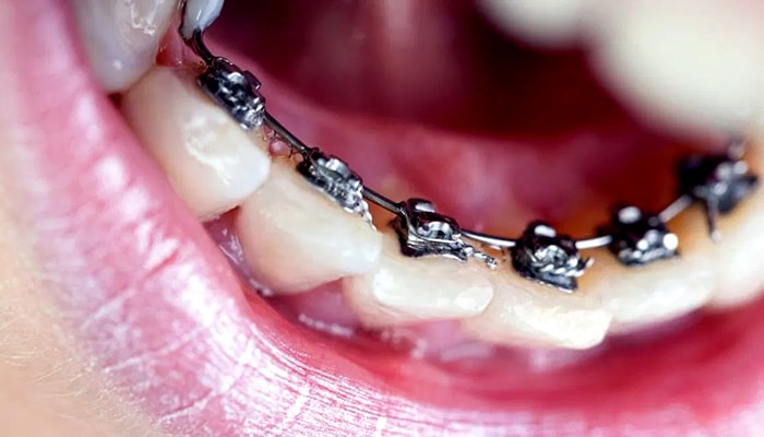 ارتودنسی لینگوال که براکت و بریس در لایه داخلی دندان نصب شده اند