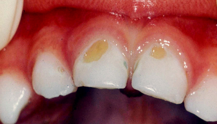 آسیب به مینای دندان در دوره ارتودنسی