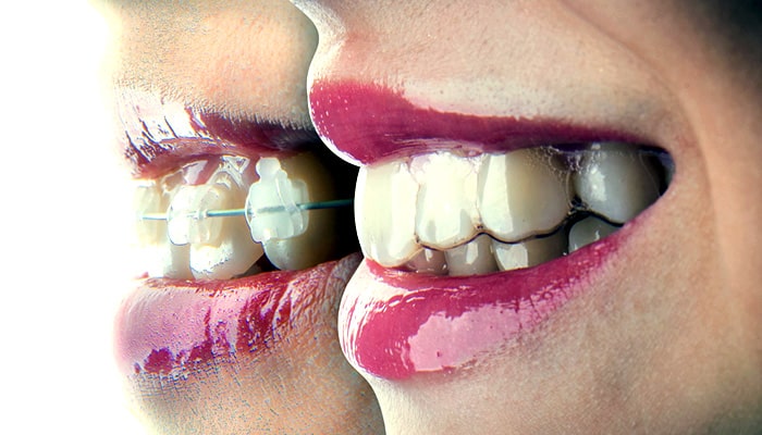 صاف شدن دندان ها با ارتودنسی بعد از 3 سال