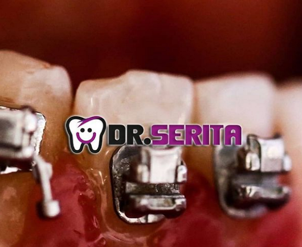 نمونه دندان ارتودنسی شده در کلینیک دکتر سریتا