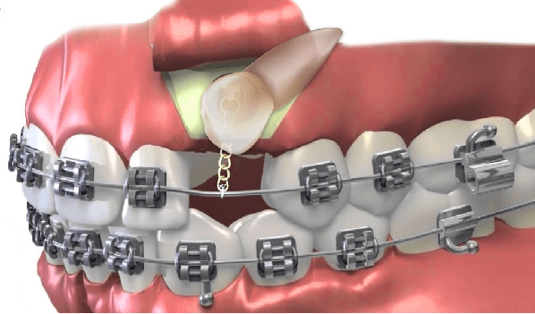 دندان نیش نهفته را می توان ارتودنسی کرد.
