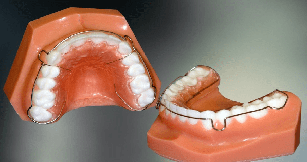 یکی از مراحل ارتودنسی متحرک دندان، قالب گیری از دندان هاست