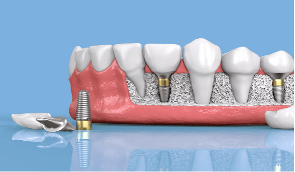 جلوگیری از تحلیل استخوان فک و حرکت دندان از اهمیت ایمپلنت است