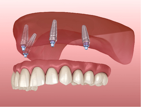 ایمپلنت دندان all on 4 در ایمپلنت کل دندانها