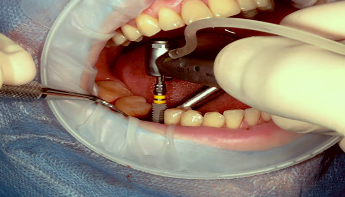 درد ایمپلنت دندان بدون جراحی کمتر است