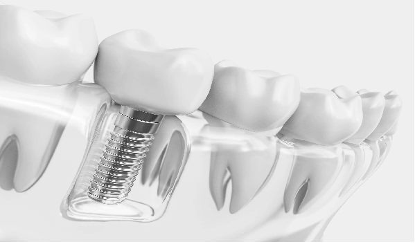 پوسیدگی دندان,دندان متحرک یا ایمپلنت,روکش دندان