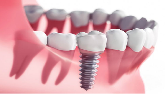 انواع ایمپلنت دندان,ایمپلنت دندان,روش جدید ایمپلنت