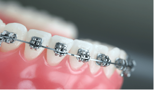 ارتودنسی دندان,ارتودنسی شفاف دندان,انواع ارتودنسی دندان