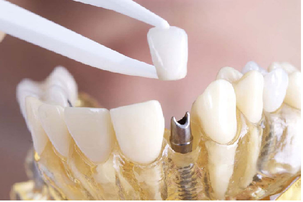 تاج دندان برای قرارگیری روی ایمپلنت دندان به کار می رود