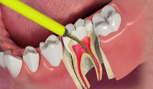 تخیله عفونت از قسمت های داخلی دندان، راه درمان عفونت است