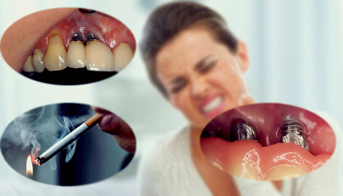 چرا ایمپلنت دندان درد دارد