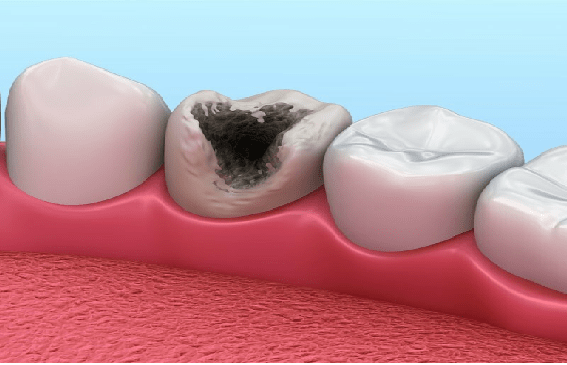 دندانی که به شدت پوسیده اگر با عصب کشی درمان نشود، باید کشیده شود