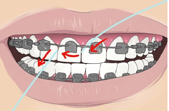نحوه صحیح کشیدن نخ دندان ارتودنسی