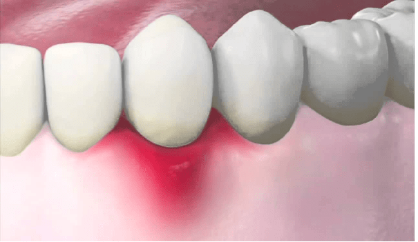 تورم و التهاب لثه، از علائم عفونت دندان