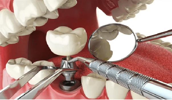 مرحله اول از ایمپلنت دندان همراه با درد خواهد بود