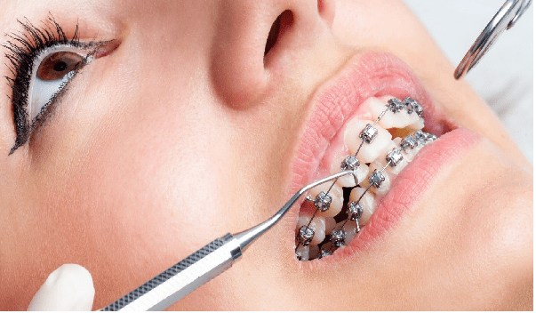انجام ارتودنسی دندان در 7 مرحله قابل انجام است