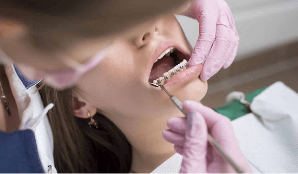 معاینه، تصویربرداری، پالیش دندان و ... از مراحل انجام ارتودنسی دندان است 