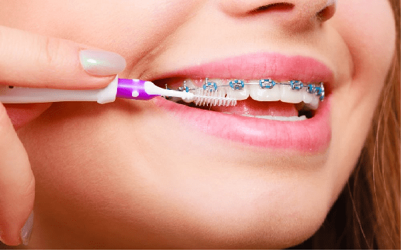 مراقبت از ارتودنسی دندان را جدی بگیرید که ارتباط مستقیم با طول عمر آن دارد