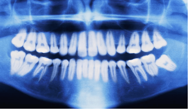 تهیه تصویر OPG از دندان ها در مرحله دوم ارتودنسی.