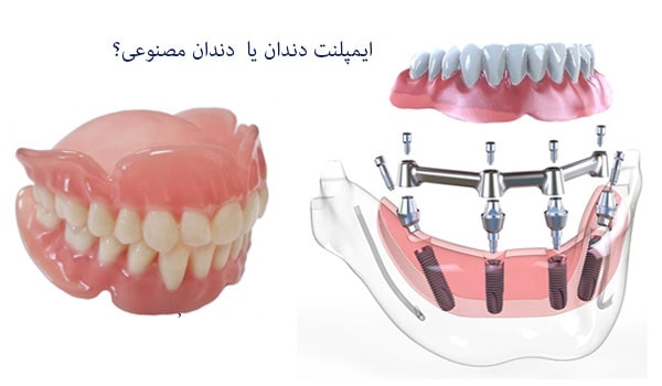ایمپلنت دندان,جایگزینی دندان,روش جدید ایمپلنت
