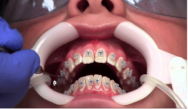 درد دندان ارتودنسی,زیبایی صورت,طرح لبخند