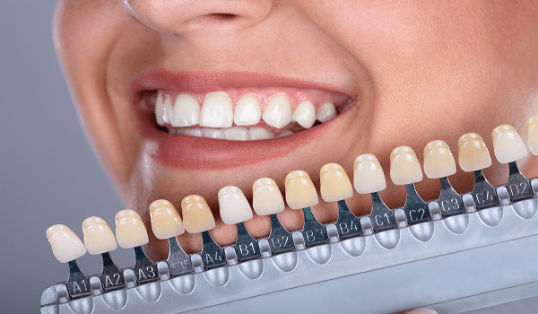 رنگ لمینت دندان a1، a2،b1 و... از انواع رنگ های لمینت دندان هستند