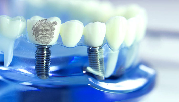 طول عمر ایمپلنت دندان