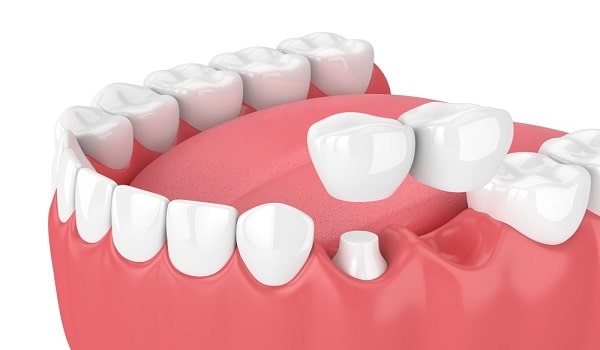 یکی از روش های نصب بریج؛ بریج کانتیلور است