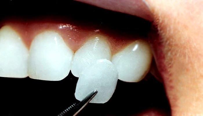 کامپوزیت دندان و درخشندگی آن