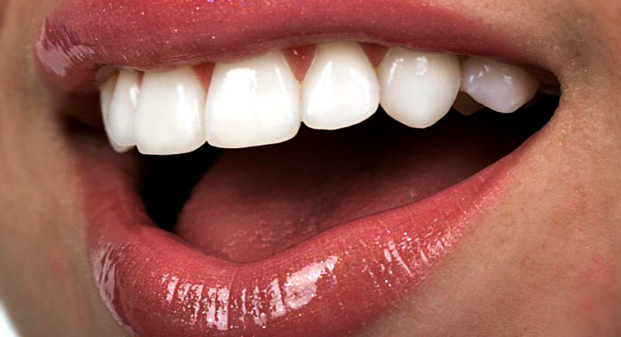 انواع لمینت دندان,ایمپلنت بهتر است یا کامپوزیت,تغییر رنگ دندان