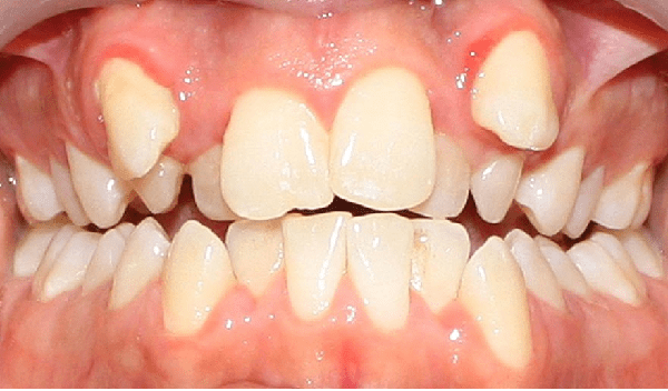 دندان نیش به صورت بیرون زده در قوس فک بالا براثر شلوغی دندان
