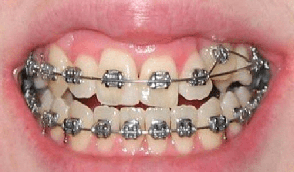 مراحل ارتودنسی دندان نیش کج فک بالا