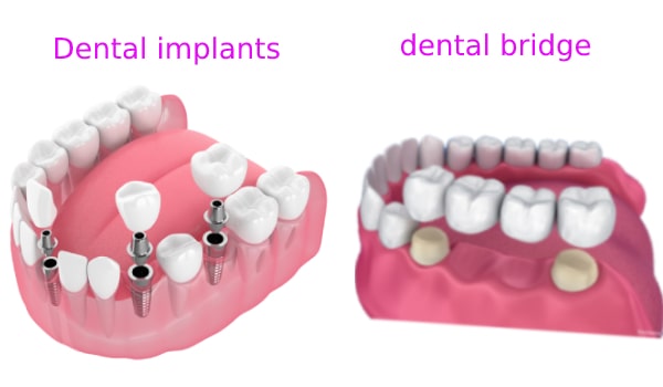 ایمپلنت یا روکش,جایگزینی دندان,درمان فاصله بین دندان