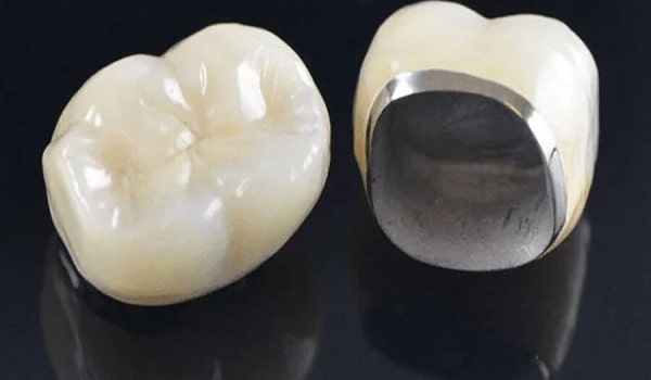 یکی از انواع بریج دندانِ؛ بریج فلز سرامیک است