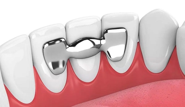 جایگزینی دندان,درمان فاصله بین دندان,طرح لبخند