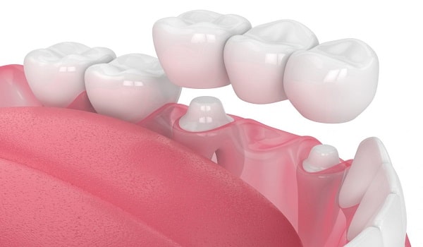 روش معمولی نصب بریج که در آن دو دندان مجاور بعد از تراش به عنوان نگهداره استفاده می شود.