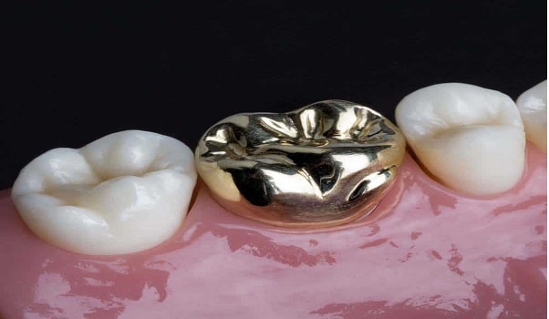 یکی از انواع بریج دندانِ؛ بریج فلزی است