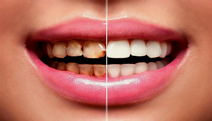 تغییر رنگ از عوارض شایع لمینت دندان