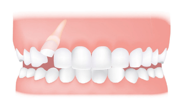 دندان نیش ممکن است نهفته در استخوان فک باقی بماند