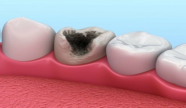 پوسیدگی دندان یکی از مواردی است که می توان در چکاپ ماهانه از آن مطلع و آن را درمان کرد