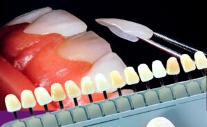 راهنمای جامع برای انتخاب رنگ لمینت دندان