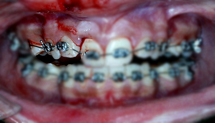بعد ارتودنسی,درد دندان ارتودنسی,درمان فاصله بین دندان