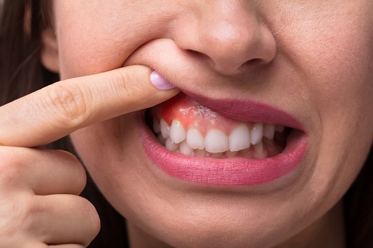 سرطان دهان یکی از مواردی است که در چکاپ ماهانه مورد بررسی قرار می گیرد