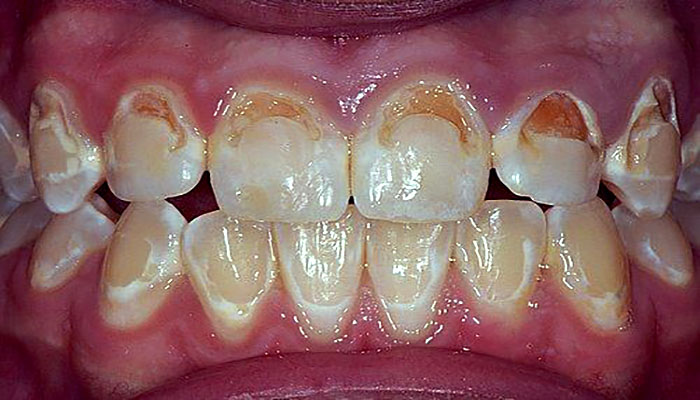 آسیب به مینای دندان، از عوارض ارتودنسی دندان