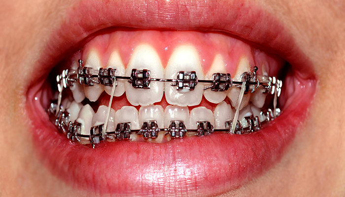 عوارض دندان ارتودنسی شده