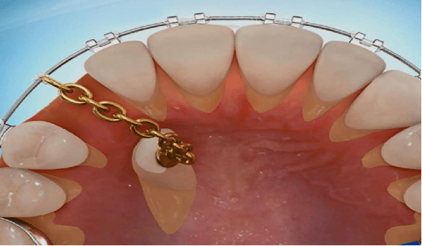 ارتودنسی دندان نیش نهفته در فک پایین.