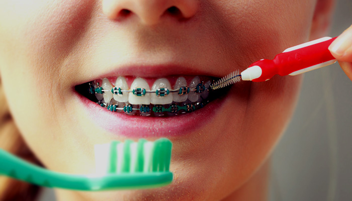 جلوگیری از بروز عوارض ارتودنسی با مراقبت از دندان ها
